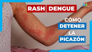 ▷ POR QUÉ OCURRE el SARPULLIDO EN EL DENGUE Y CÓMO CONTROLAR EFICAZMENTE [upl. by Yendroc]