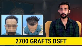 2700 Grafts hair transplant  DSFT  2700 Grafts  Hair transplant result  Satya Hair Clinic [upl. by Ahsiekar]