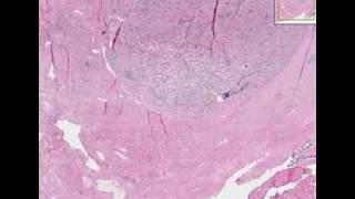 Histopathology ProstateAdenocarcinoma [upl. by Aciruam]