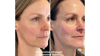 Skin Tightening Facial with Topical Neurotoxin Alt to injectable Botox [upl. by Benni]