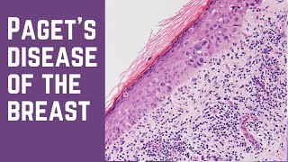 Pagets Disease of the Breast  Pathology mini tutorial [upl. by Selwyn]