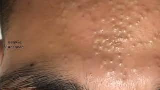 Forehead Acne amp Blackhead Treatment  Blackhead Removal on forehead removeblackhead [upl. by Adalie]