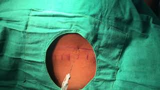 LANDMARK GUIDED THORACIC PARAVERTEBRAL BLOCK [upl. by Rednav163]