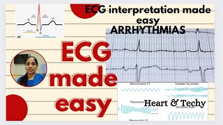 ECG interpretation is easy now [upl. by Ecnarrot]