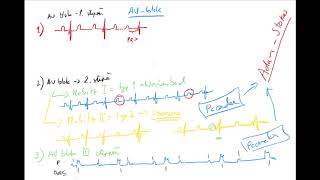 EKG 5 by Coiled CZECH AV bloky Mobitz Wenckebach blok levého LBBB a pravého Tawarova raménka [upl. by Lenra]