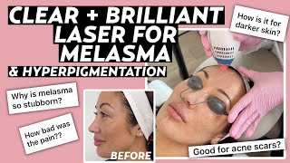 Clear  Brilliant Laser for Melasma Dermatologist Answers FAQs with Before amp After Results [upl. by Dave]