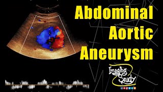 Abdominal Aortic Aneurysm  Ultrasound  Doppler  Case 139 [upl. by Eynenihc]