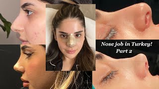 I GOT A NOSE JOB IN TURKEY WITH THE BEST SURGEON  PART 2 NOSE REVEAL  CLINICHUB [upl. by Lerrej]