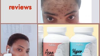 MY HONEST REVIEW ON KALLISTIA ACNE CLEANSE [upl. by At831]