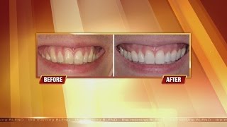 Get Rid Of Receding Gums 6115 [upl. by Vernita]