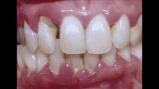 Periodontitis  Cure your Gum with Dr Mark Bonner [upl. by Tonia]