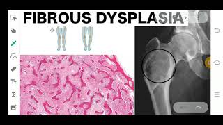 FIBROUS DYSPLASIA  ORAL PATHOLOGY  BONY DEFECT [upl. by Bo]