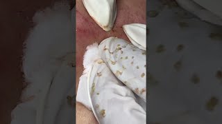 Big Cystic Acne Blackheads Extraction Blackheads amp Milia Whiteheads Removal Pimple Popping [upl. by Cassius]