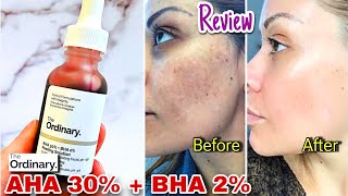 The Ordinary AHA BHA Peeling Solution Review  MAGIC in a Bottle🤔 [upl. by Ikila]