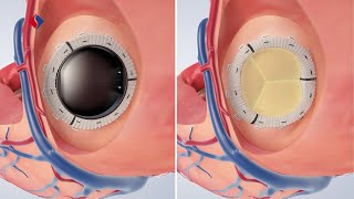 Mitralklappeninsuffizienz OP  Medizinische Animation [upl. by Asfah]