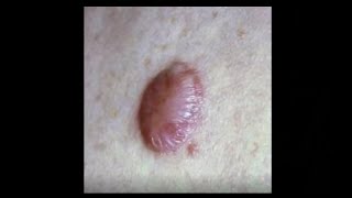 What are keloid scars and how to treat them [upl. by Nwahsaj]