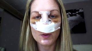 Septoplasty Recovery  Day 4 revision [upl. by Vinson]