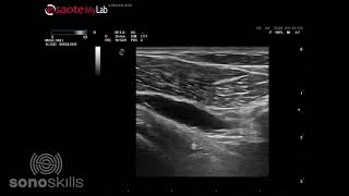 Subcoracoid bursitis during active external internal rotation [upl. by Arraes]