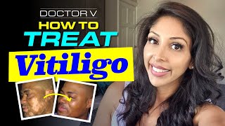 Doctor V  How To Treat Vitiligo  Skin Of Colour  Brown Or Black Skin [upl. by Giuliana]