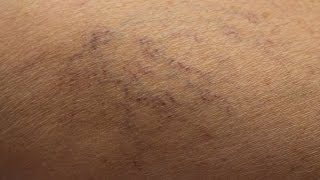 Sclerotherapy Spider Vein Removal [upl. by Jaime]