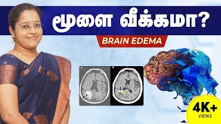 மூளை வீக்கமா  Brain Edema  Brain Health Problem Tamil  Dr Veni  RockFort Neuro Centre  Trichy [upl. by Alcina]