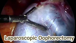 Laparoscopic Oophorectomy Both Side Ovaries  With In 10 Minutes  Step By Step  Day 83100 [upl. by Filippo640]