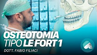 Chirurgia ortognatica  Osteotomia tipo Le Fort I [upl. by Gare]