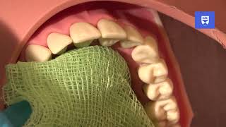 Management of an avulsed permanent tooth [upl. by Ainna]