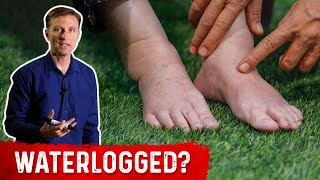 Fluid Retention On Keto Diet  Dr Berg [upl. by Nosyt]