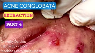 Mụn trứng cá mạch lươn nặngDermatologistpimpleswhiteheadacne conglobata extraction bef 7ws aft [upl. by Rebah]