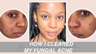 How I Cleared My Fungal Acne [upl. by Aynnat]