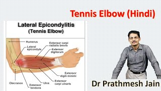 Tennis Elbow  a Common mans Perspective Hindi [upl. by Aseeram]