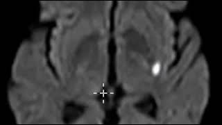 Acute lacunar infarction basal ganglia [upl. by Ecadnac]