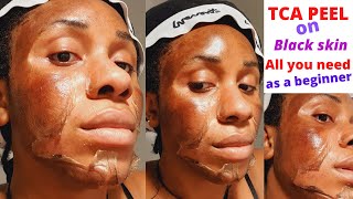 How to TCA peel Tutorial by Dermatologist [upl. by Acinomad]