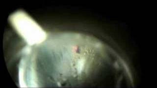 Laser Peripheral Iriditotomy to Prevent Glaucoma Part 2 [upl. by Ettigirb]