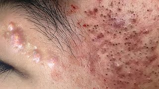 Big Cystic Acne Blackheads Extraction Blackheads amp Milia Whiteheads Removal Pimple Popping  3532 [upl. by Etireuqram]