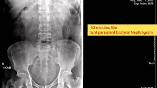 CASE 109 IVP bilateral Delayed faint persistent nephrogram [upl. by Ariane]