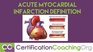 ICD10 Subsequent Acute Myocardial Infarction Definition [upl. by Mitran958]