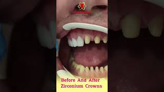 Before and After Zirconium Crowns dentist dental [upl. by Aihsiym720]