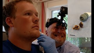 POV Ear wax removal Headphones make patient deaf [upl. by Sualocin]