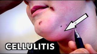 RARE CELLULITIS amp Impetigo Ultra Funny Kid  Dr Paul [upl. by Lotus268]