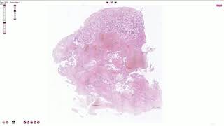 Choriocarcinoma  Histopathology [upl. by Yntruoc]