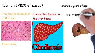 Primary biliary cirrhosis Primary biliary cholangitis Simply Explained [upl. by Ainegue]