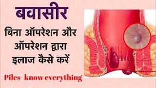 बवासीर  बिना ऑपरेशन और ऑपरेशन द्वारा इलाज कैसे करें  Piles  Hemorrhoids [upl. by Ennayt]