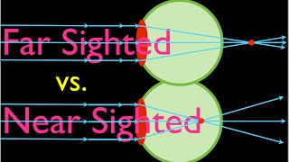 Farsighteness vs Nearsightedness An Explanation [upl. by Atinrahs]