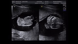 fetal ultrasound of 20 weeks 21 weeks baby boy moving [upl. by Three]