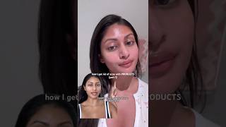 How I Get Rid Of Acne With Products Part 1 [upl. by Ocsirf211]