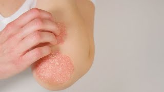 Tratamientos para la psoriasis [upl. by Ruscher]