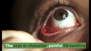 The stye or chalazion painful eyelid [upl. by Frodine]