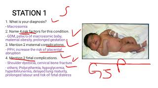 Macrosomia Case Study [upl. by Murdoch]